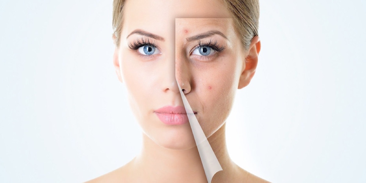 Acne at Beauty Bar by Akhlas