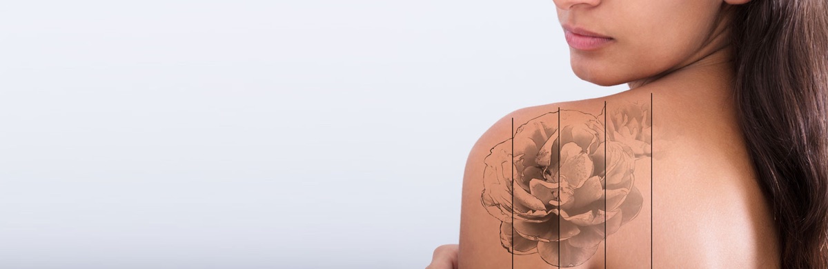 Laser Tattoo Removal