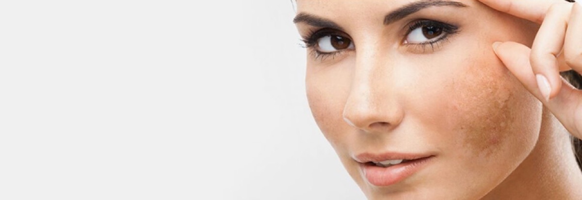 Treatment & Control of Melasma at Beauty Bar by Akhlas
