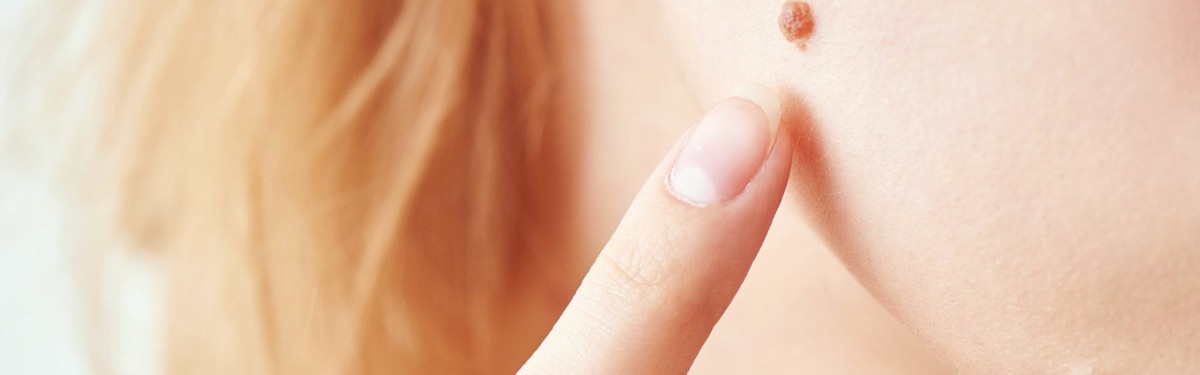 Skin Tag & Mole Removal at Beauty Bar by Akhlas