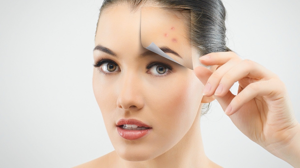 Whiteheads & Blackheads at Beauty Bar by Akhlas