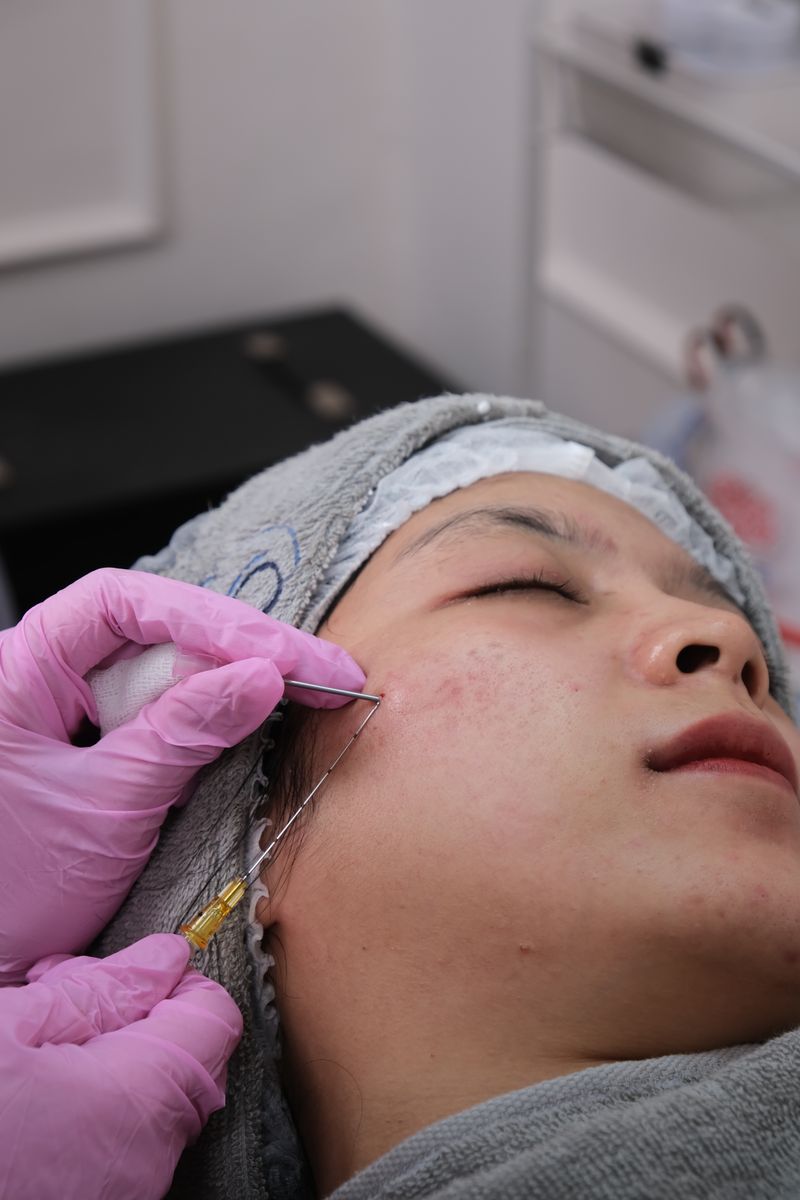 Microneedling treatment
